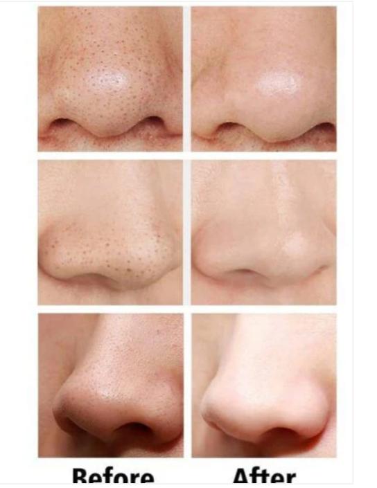 Blackhead & Dead Skin Remover High-Quality Synthetic Material